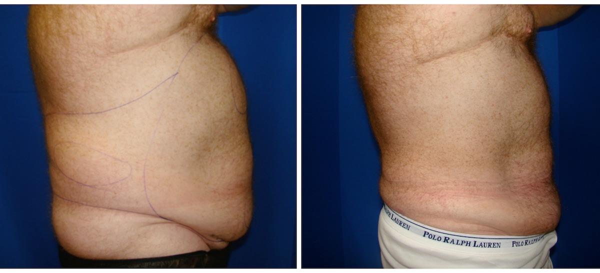 Why Are Cosmetic Procedures Like Liposuction Stigmatized