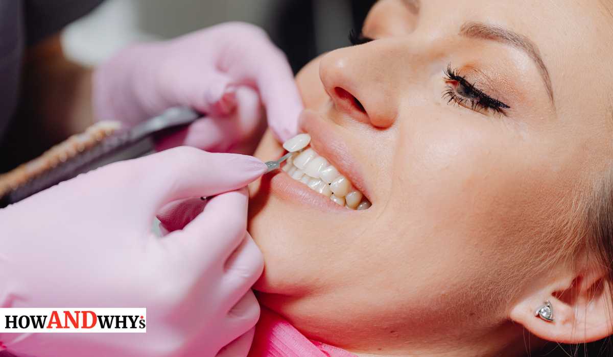 When Do You Need to Replace Veneers? How and Why's