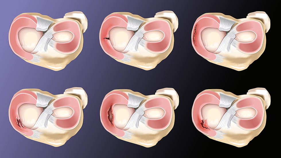 Bucket Handle Meniscus Tear Howard J. Luks, MD