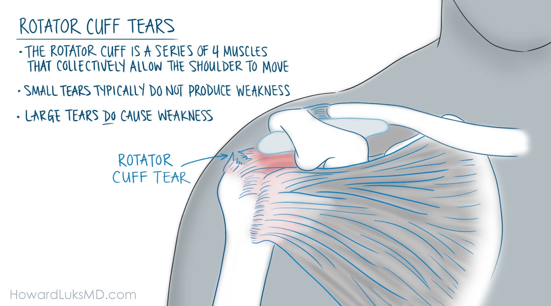 Rotator Cuff Tear Symptoms Pain