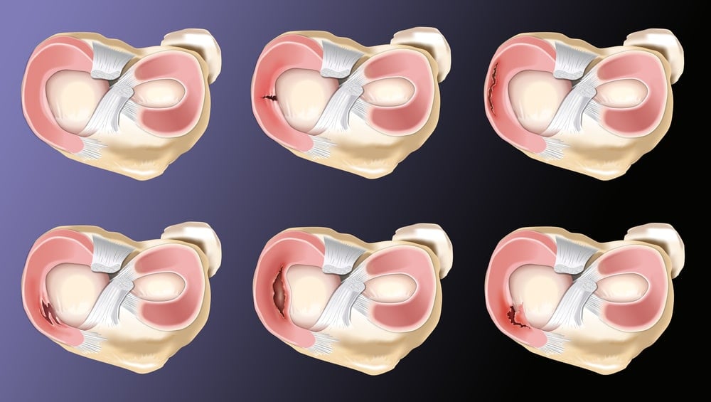 Types of Meniscus Tears Howard J. Luks, MD