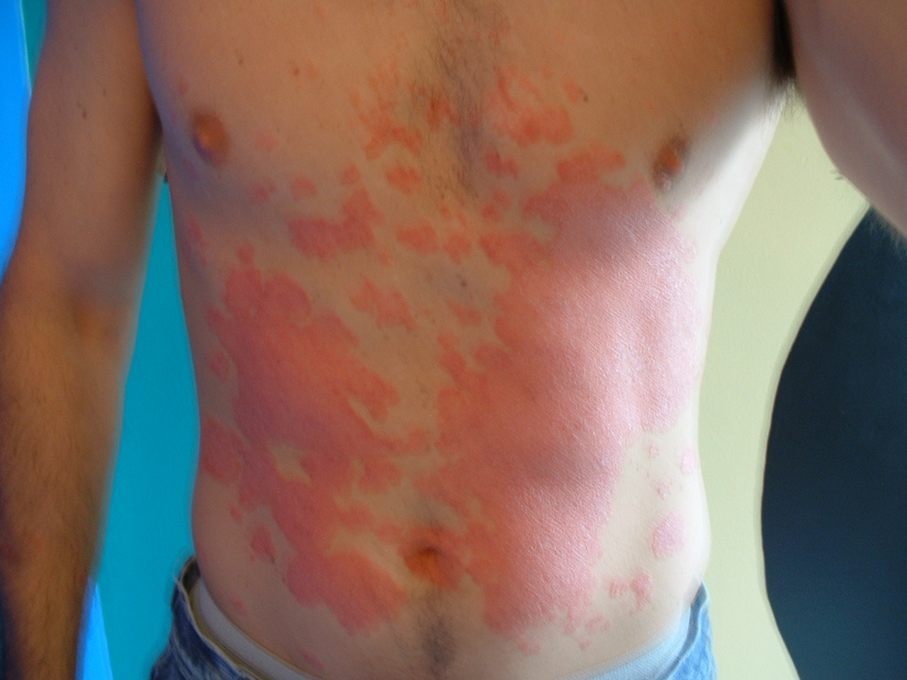 7 Ways to Reduce Inflammation to Help Your Psoriasis