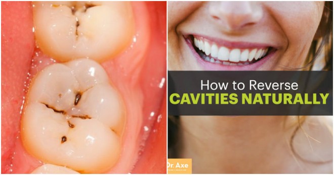 How to Reverse Cavities Naturally & Heal Tooth Decay With Home Remedies