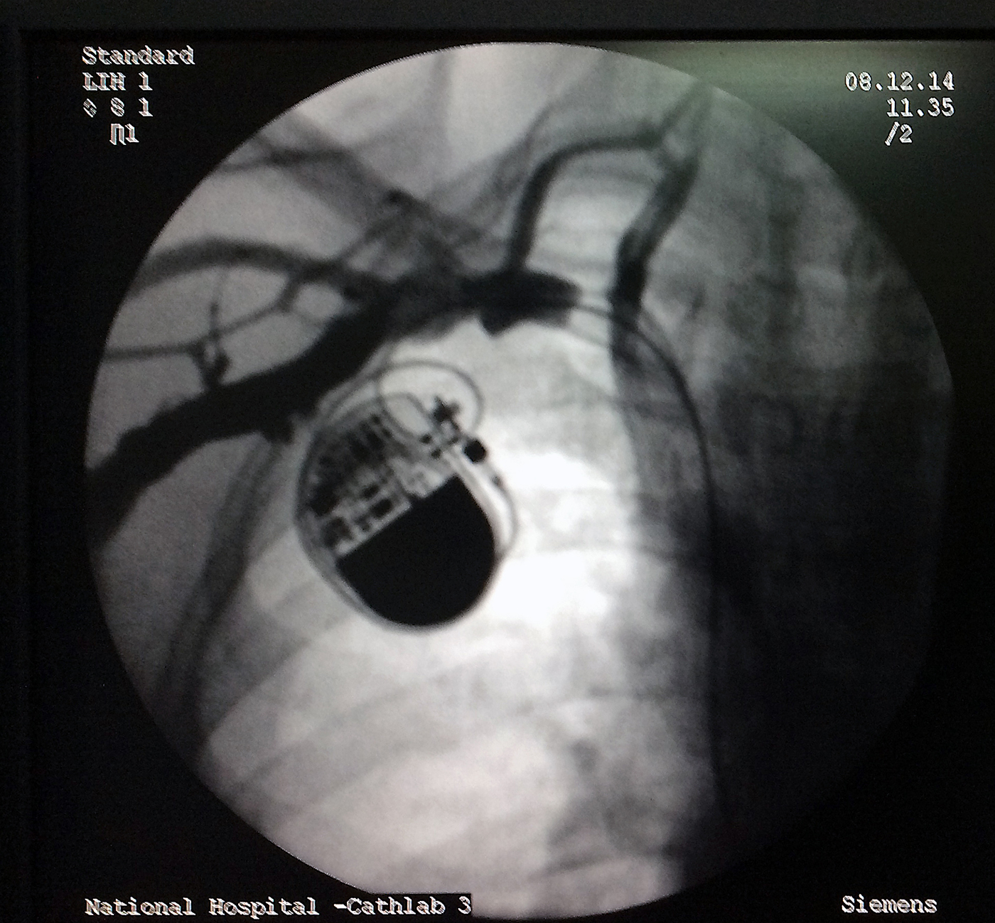 Role of Venography How to Pace