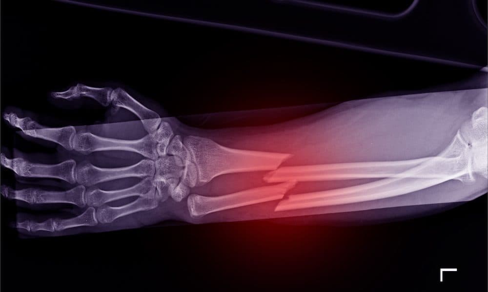 3D simulations may help with healing of broken bones Health Tech World