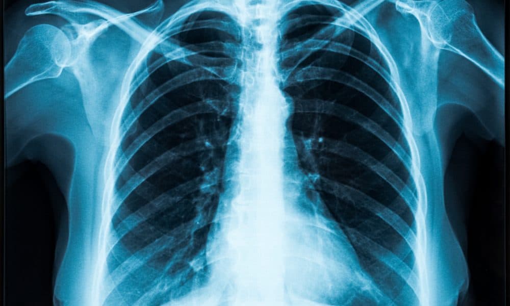 AI predicts heart disease risk from single Xray