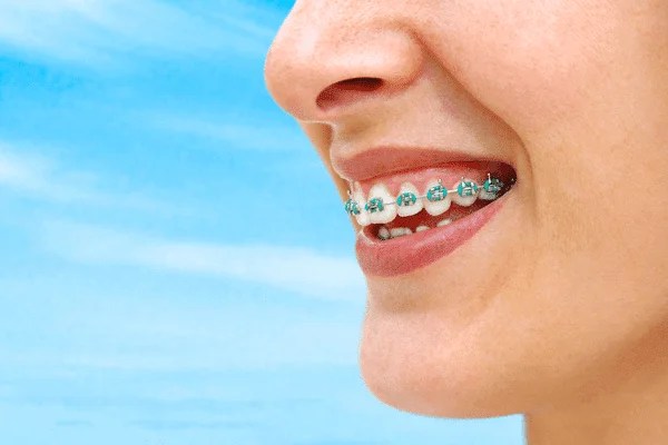 What's the Best Age To Get Braces?