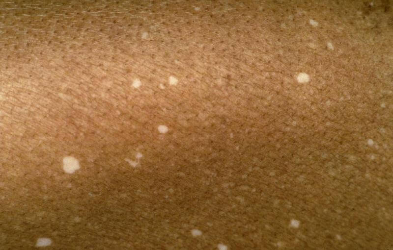 Idiopathische gutatte hypomelanose