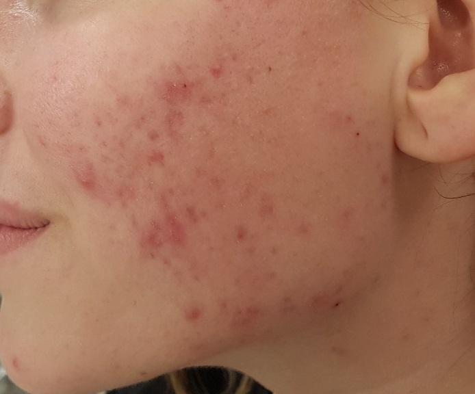 Acne | Huidtherapie Wijhe