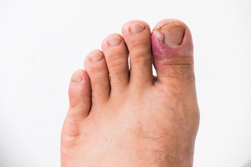 Avoiding Ingrown Toenails Henry Slomowitz, D.P.M. & Associates