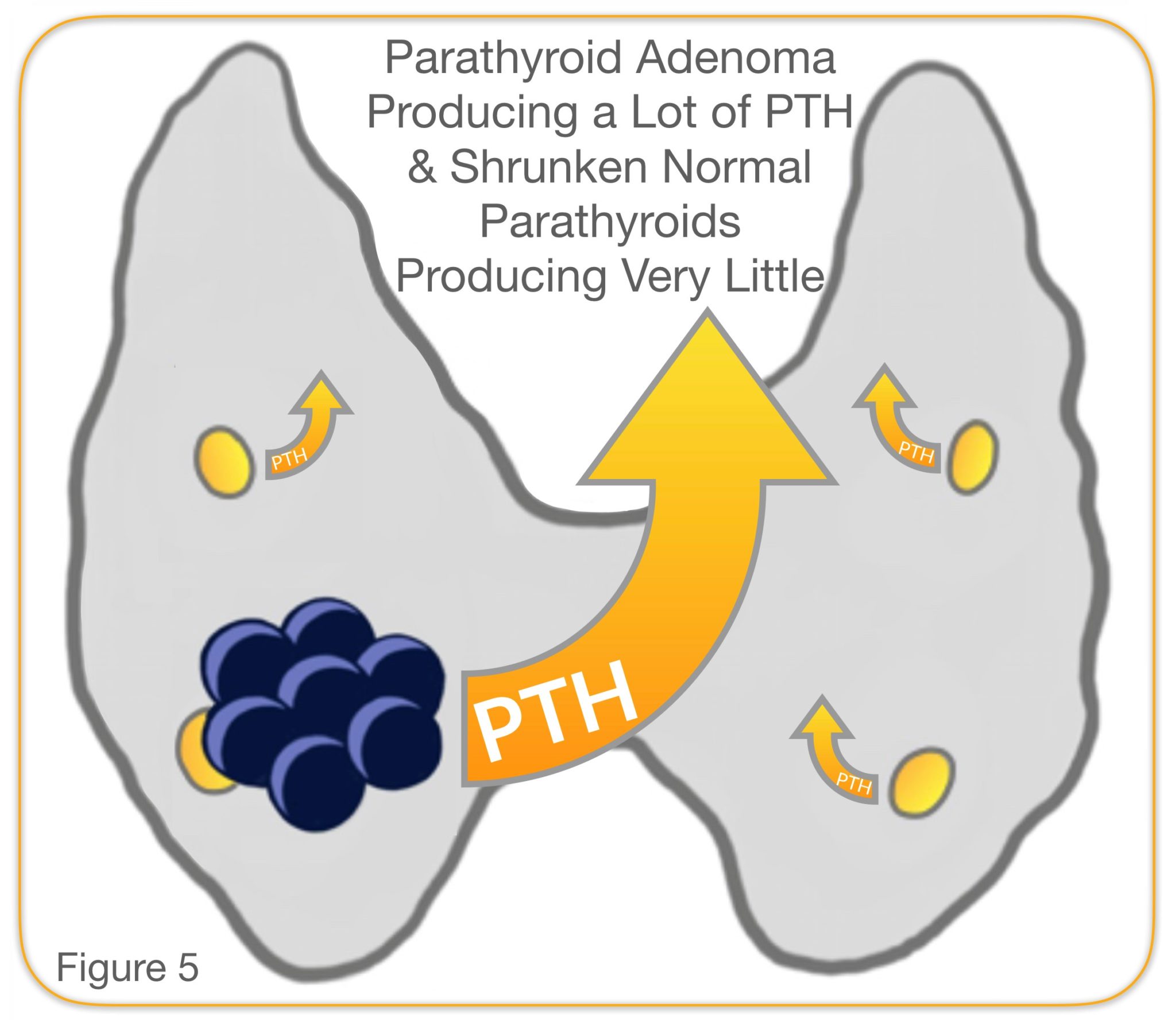 Parathyroidectomy Parathyroid Gland Removal Surgery Dr. Larian