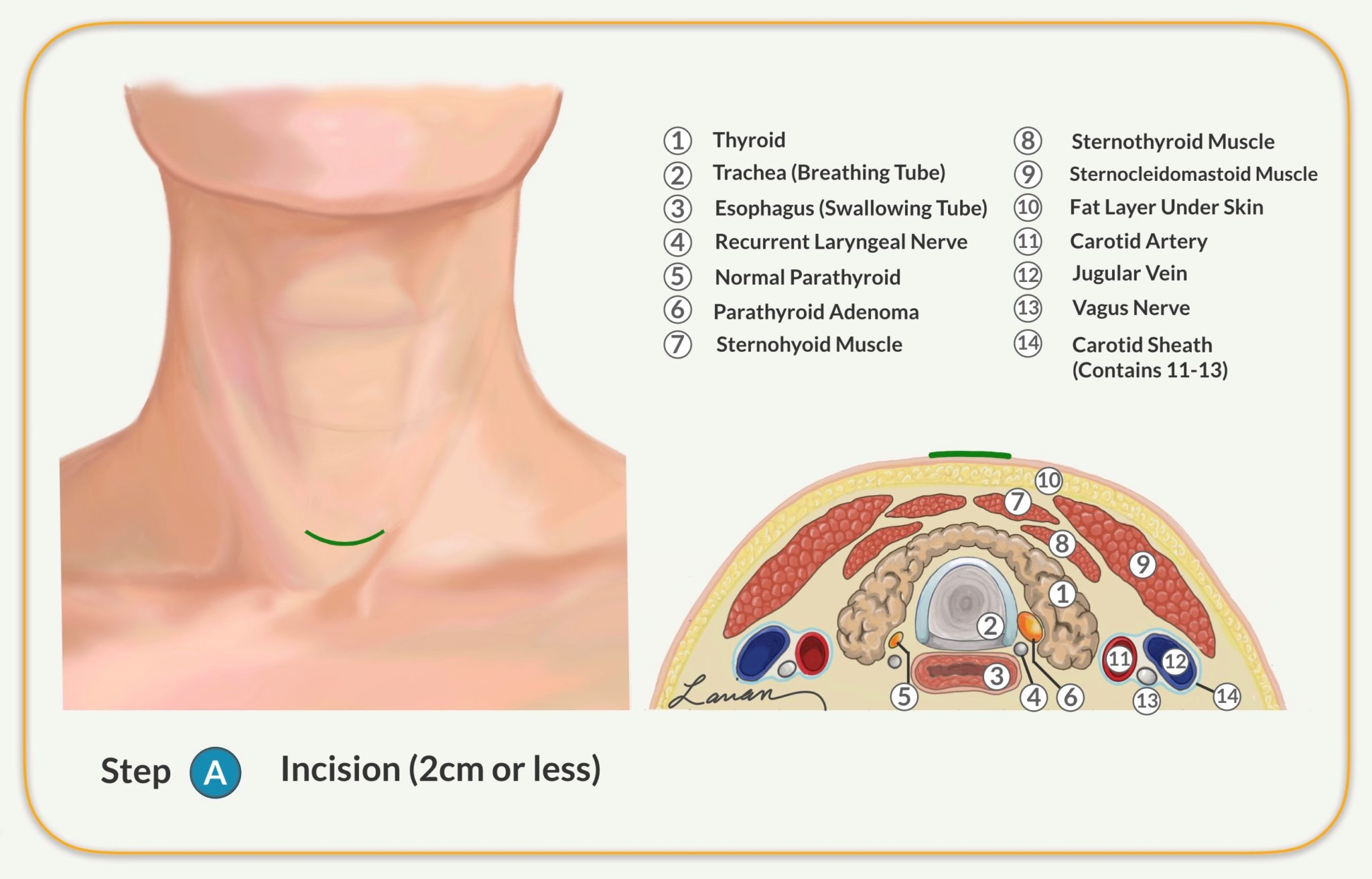 Parathyroidectomy Parathyroid Gland Removal Surgery Dr. Larian
