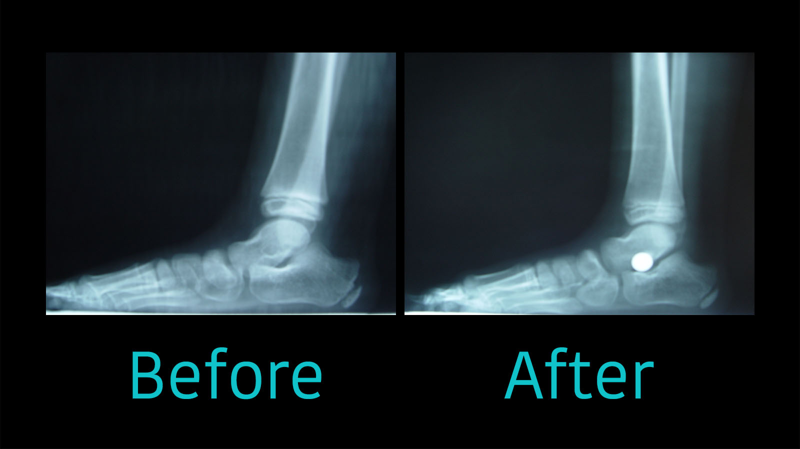 What Is Flat Feet Surgery at Anita Knutson blog