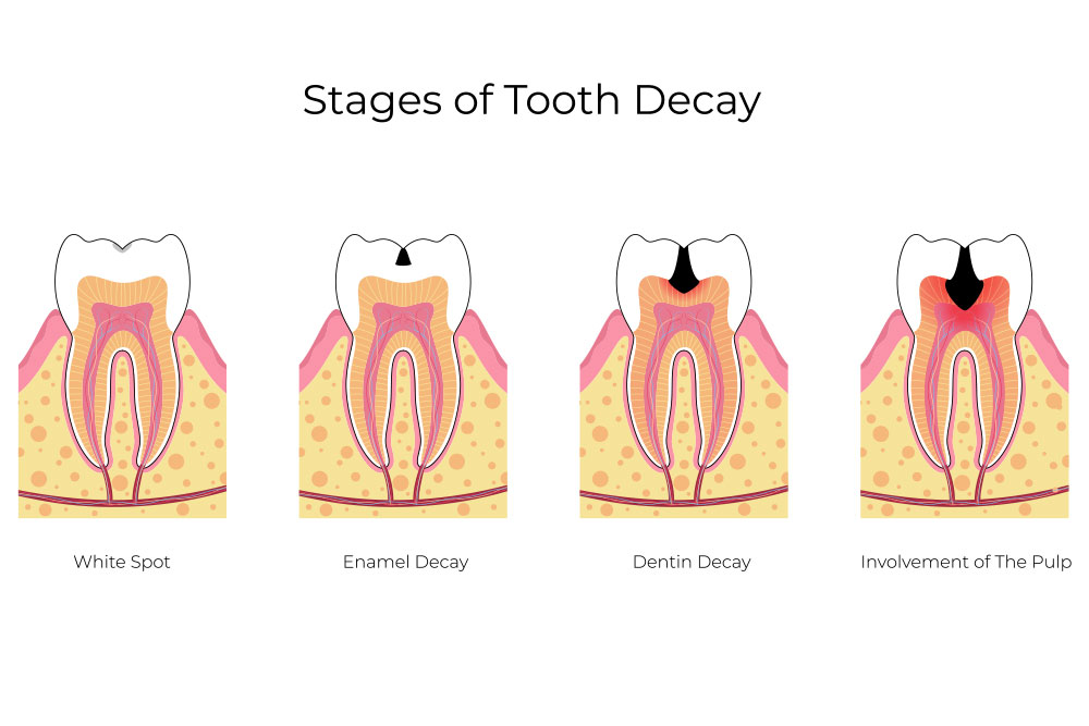 Tooth Decay iSmile Dental