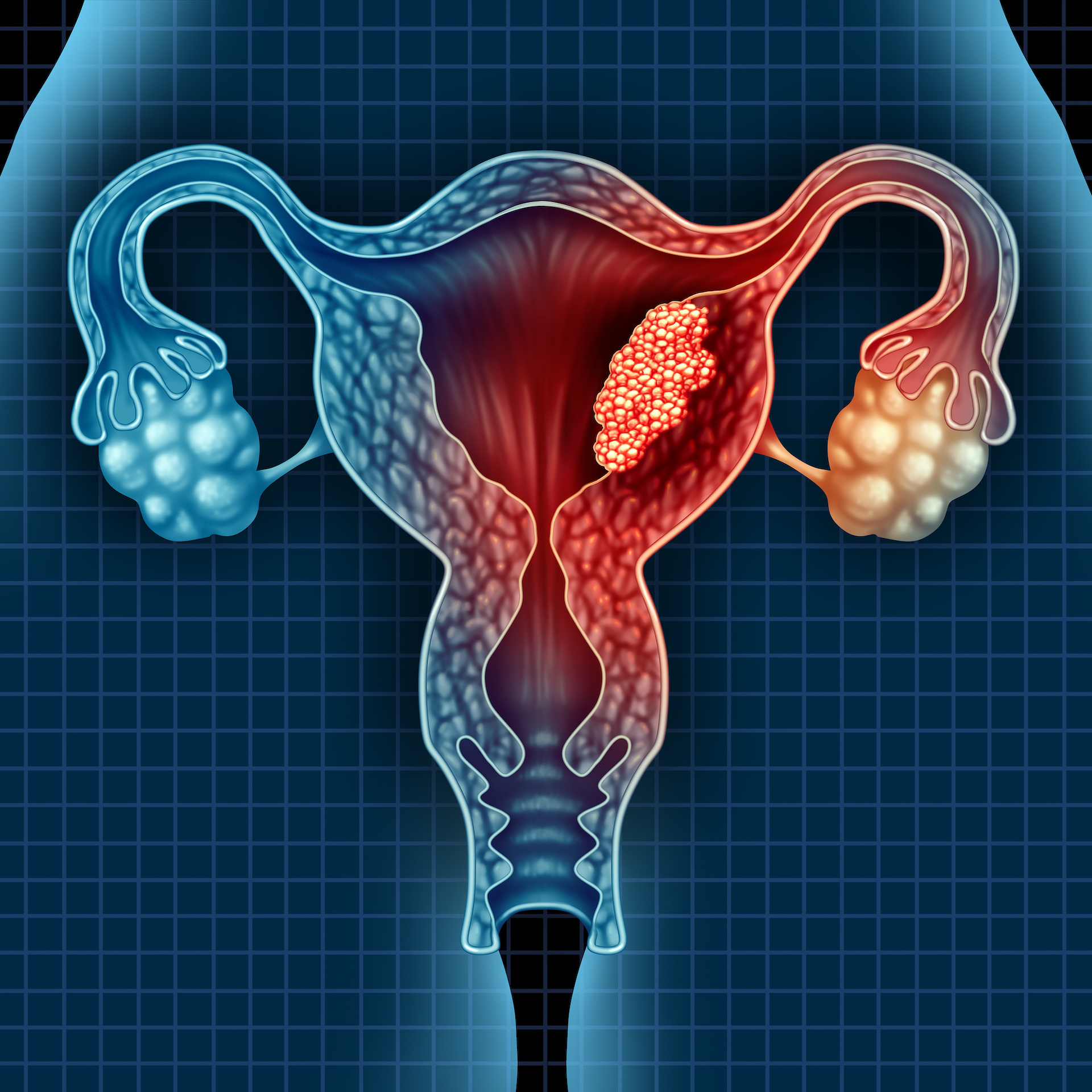 Endometrial and cervical cancer Insights into Imaging