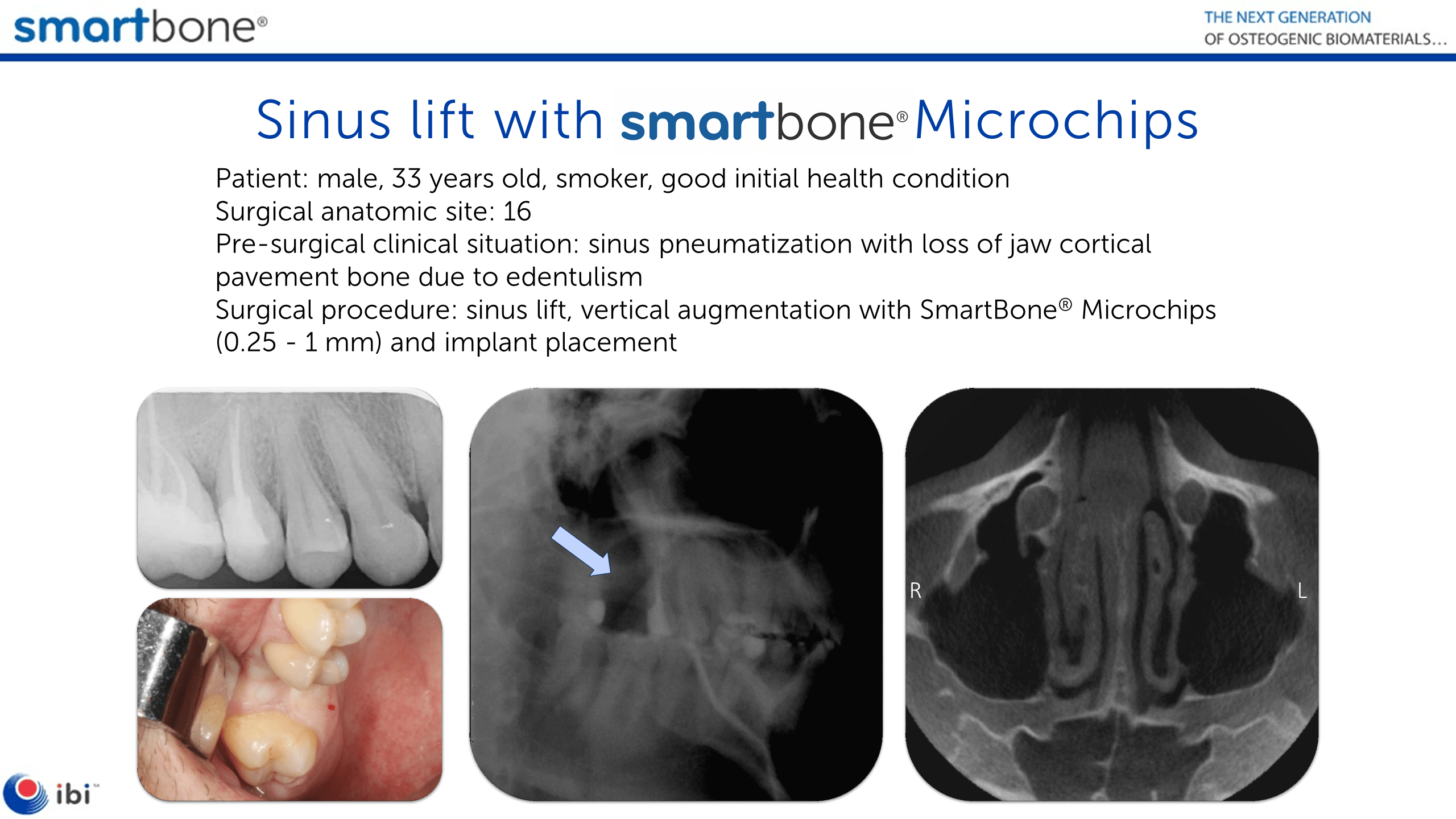 Sinus lift, vertical augmentation with SmartBone Microchips and implant