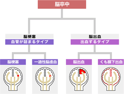 脳出血の後遺症【My介護の広場】 脳疾患あれこれ-症状や原因-予防などについて | 一ノ宮脳神経外科病院