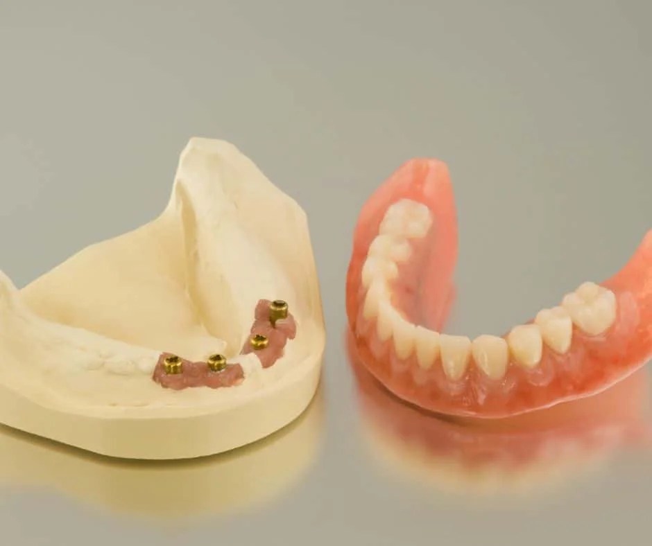 Implant Dentures Premier Dentures