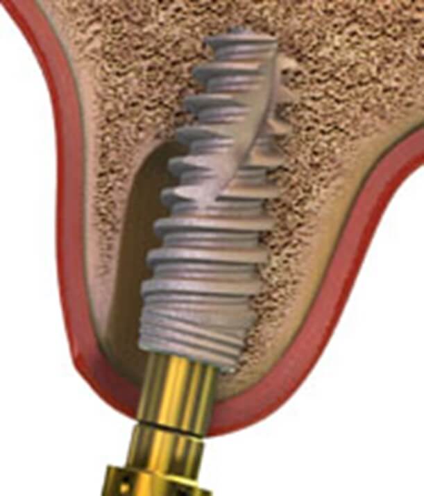 Why are dental implants so expensive? The 411 on this contemporary