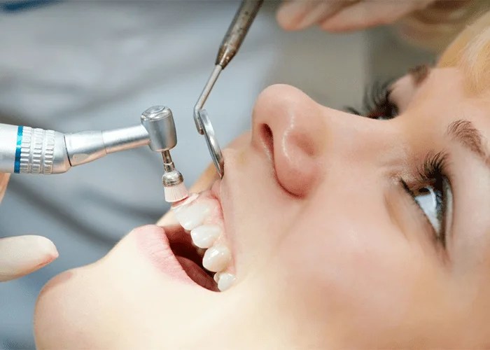 Teeth Scaling and Polishing in Lahore