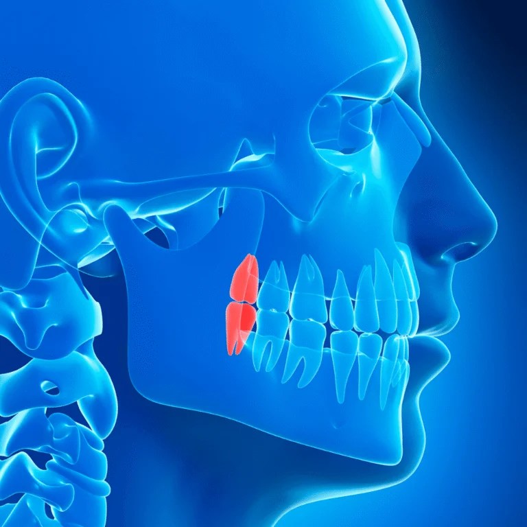 Wisdom Teeth Surgery in Lahore