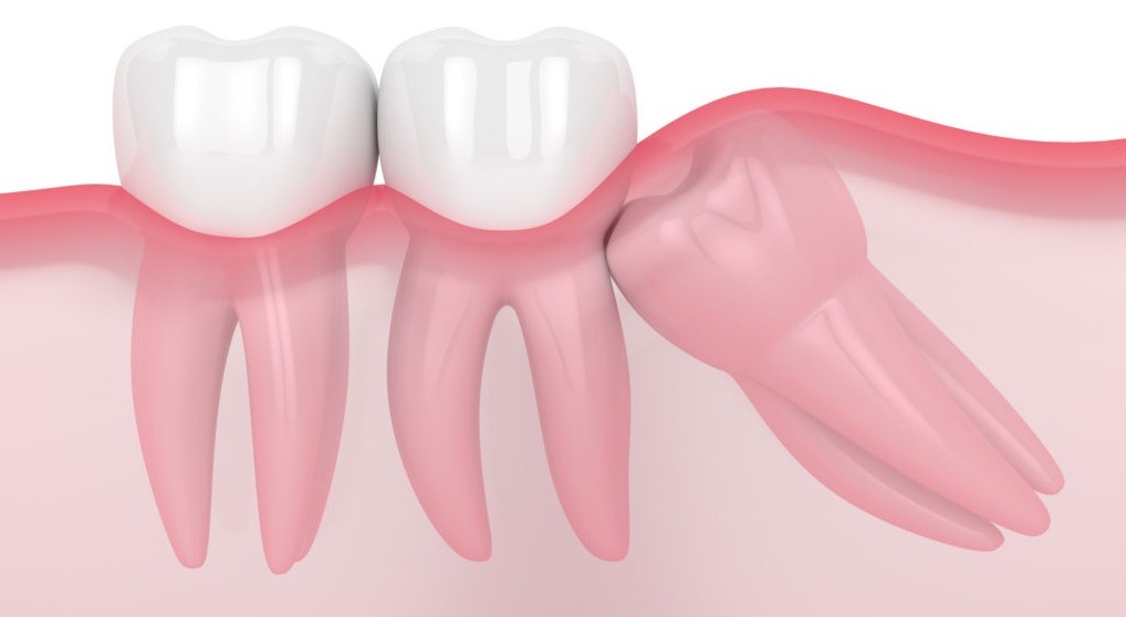 Wisdom Teeth Removal Canberra Identity Dentistry