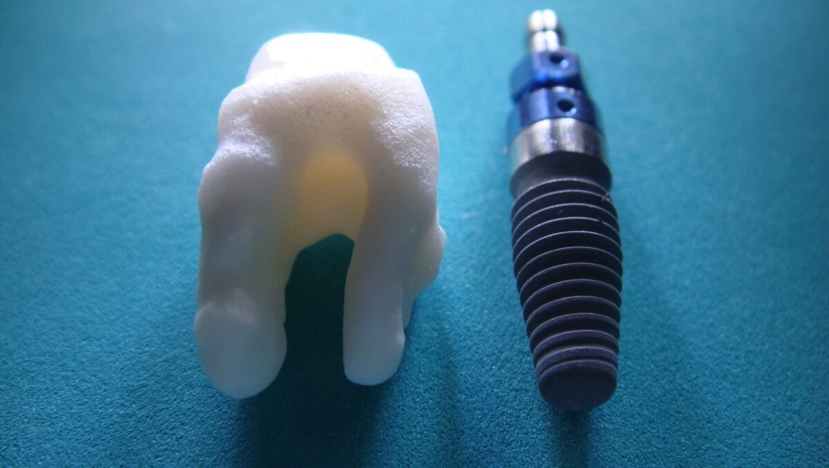 Implants Titanium vs. Zirconia Integrative Dental Specialists of