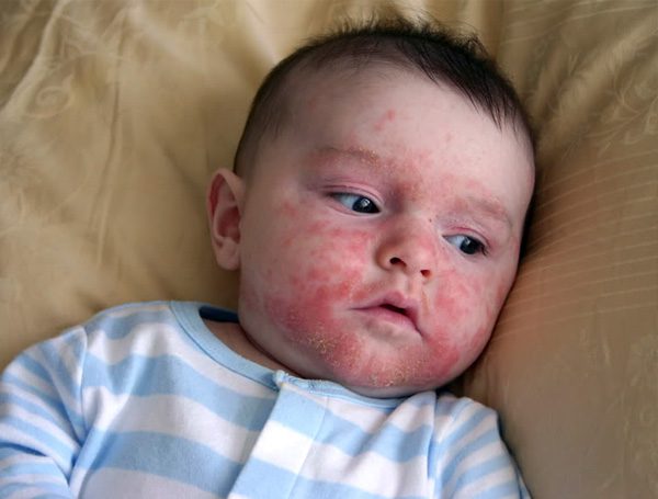 Signs and Treatment of Cradle Cap in Babies IFMCH Bridging the Gap