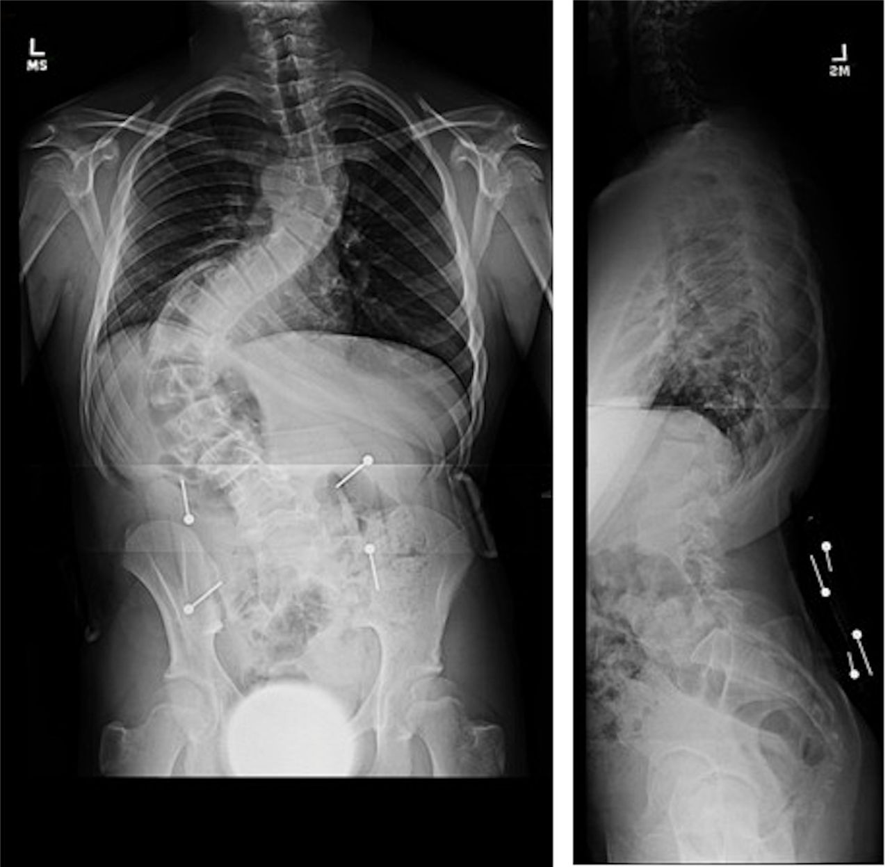 Idiopathic Scoliosis: The Harms Study... MedOne, Thieme