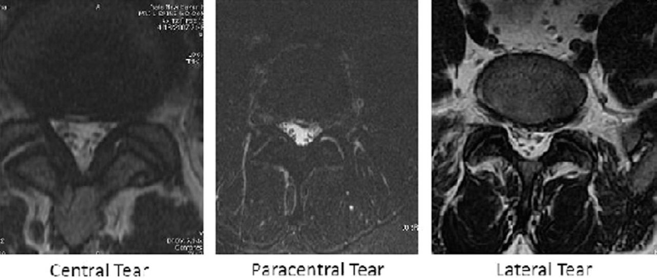 Do presence and location of annular tear influence clinical