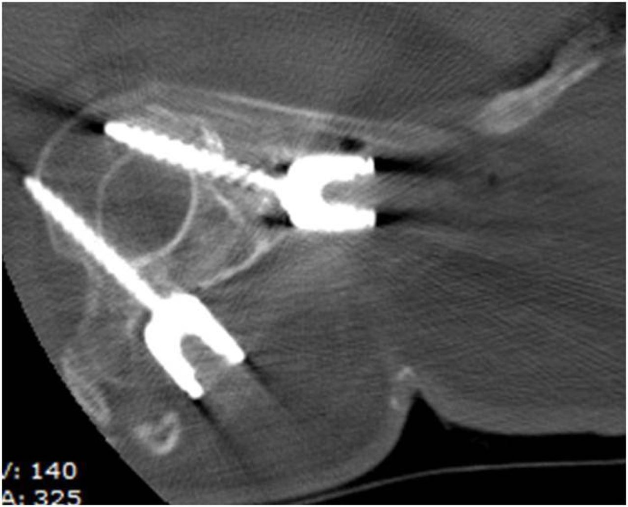 Inter and IntraObserver Reliability of Measurement of Pedicle Screw