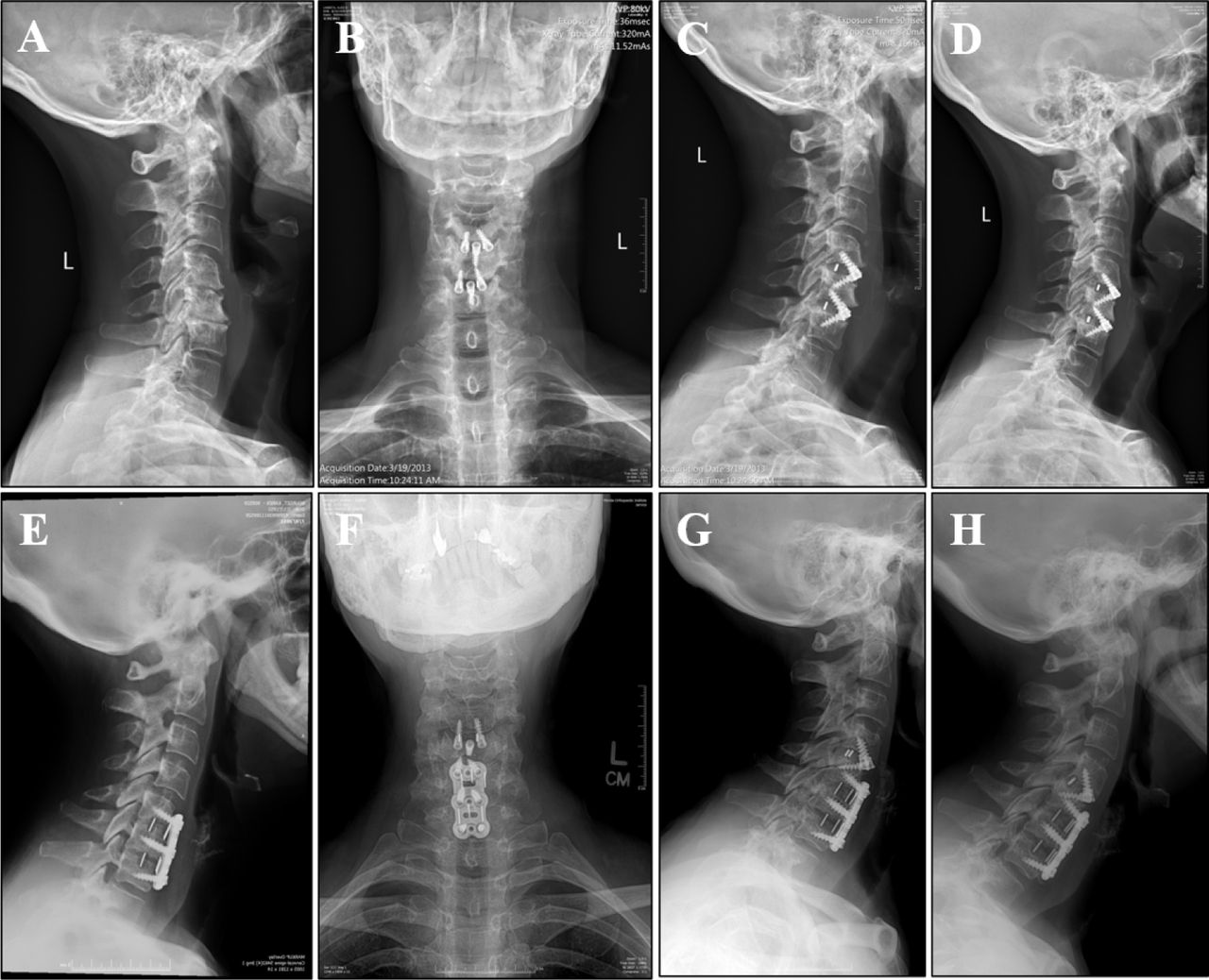 Early Radiographic and Clinical Study Evaluating an Integrated