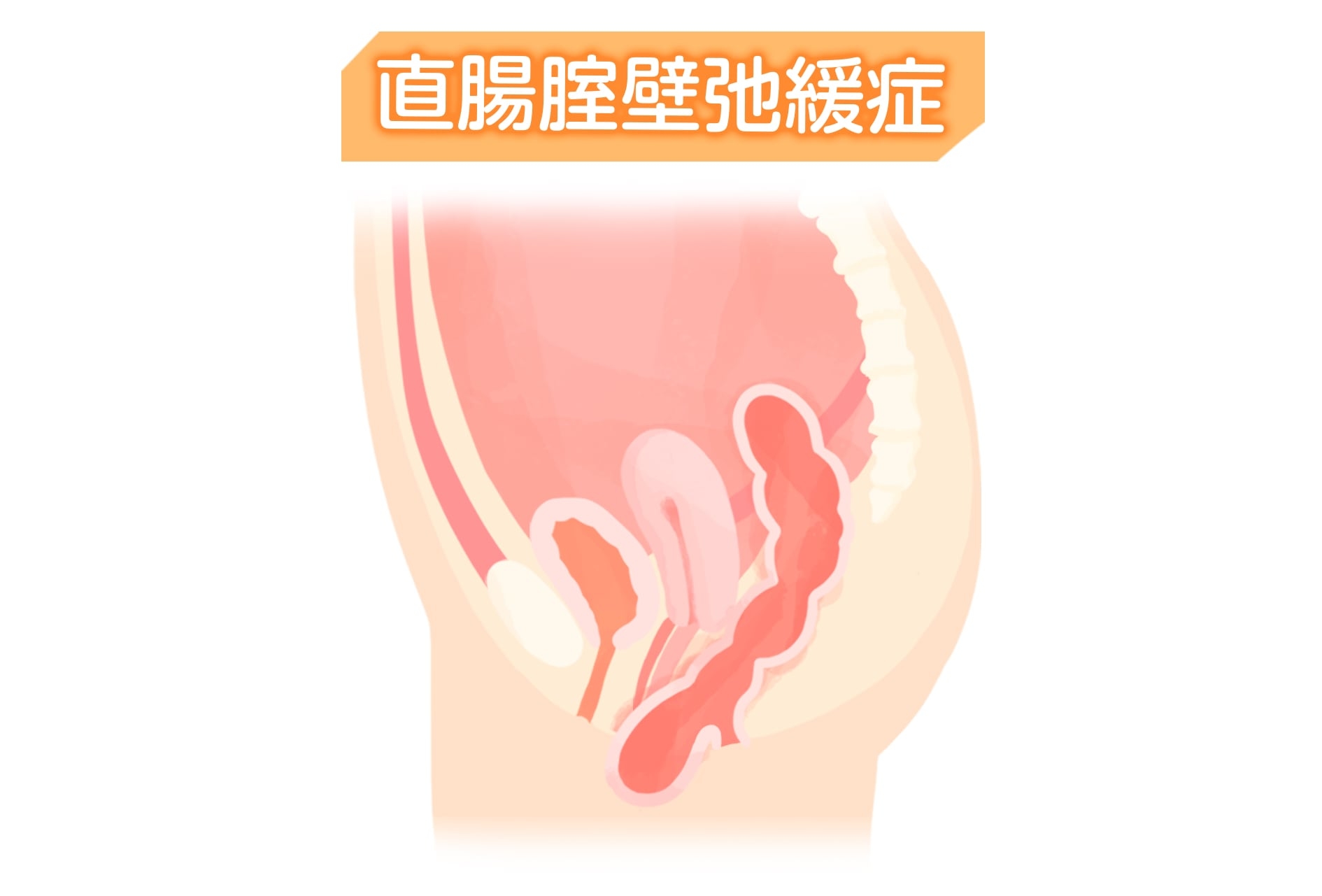 便意はあるのになかなか出ない…ずっとすっきりしない理由とは？‐Ilacy(アイラシイ)働く女性の医療メディア