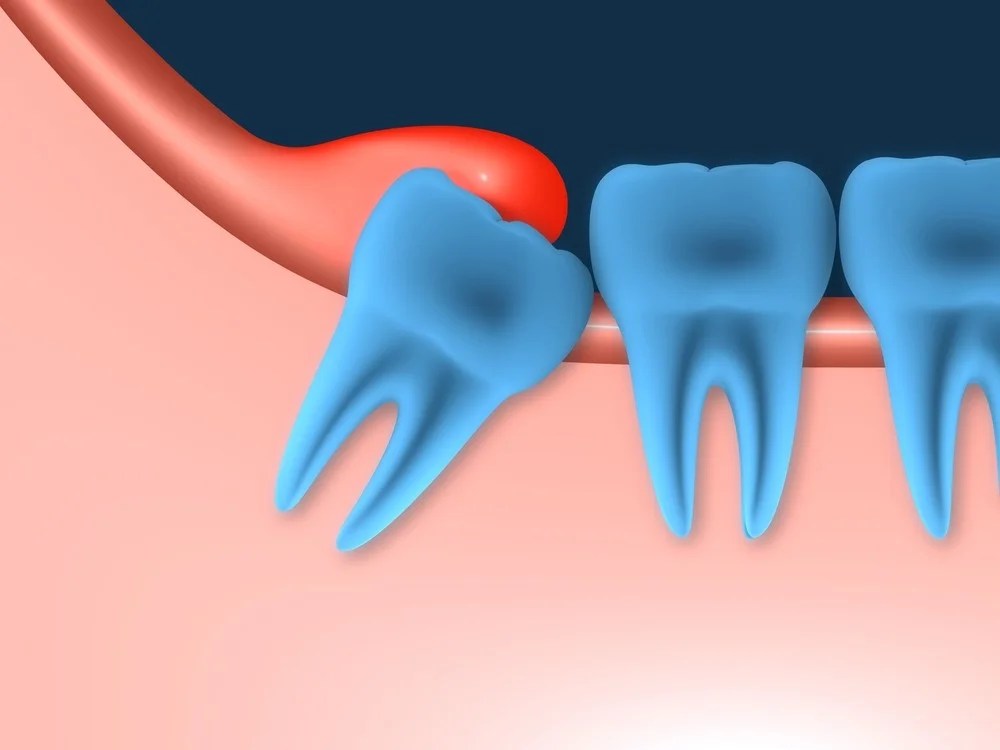 What are wisdom teeth and reasons to get them removed? ILAJAK Medical