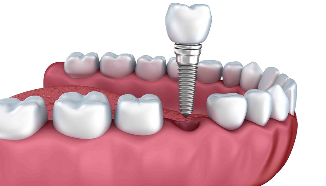 Top & Best dental implant brands ILAJAK Medical