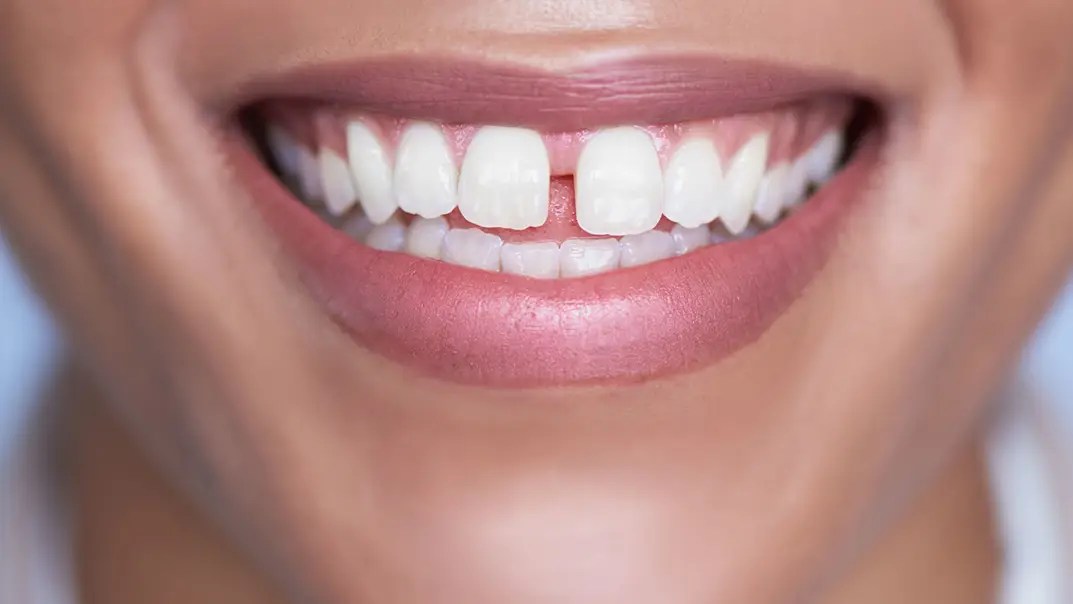 Best 3 ways to fix teeth gap without braces ILAJAK Medical