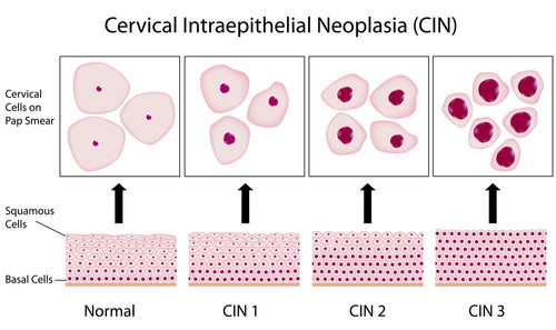 Abnormal Pap HPV in Queens & Long Island, NY The Woman's Health