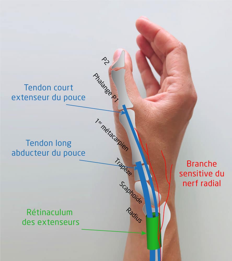 La tendinite de De Quervain
