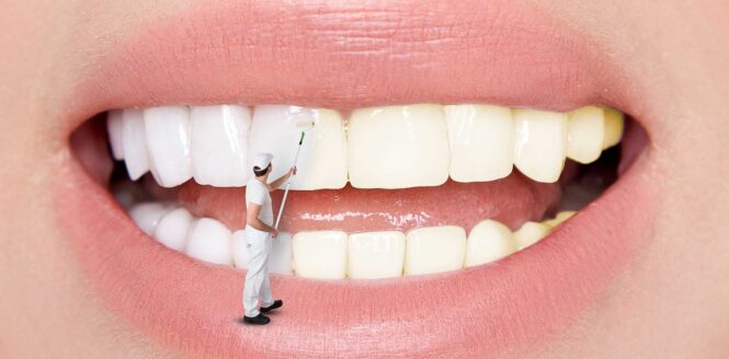 Stains on Your Teeth Types, Causes And Removing Options Imagup