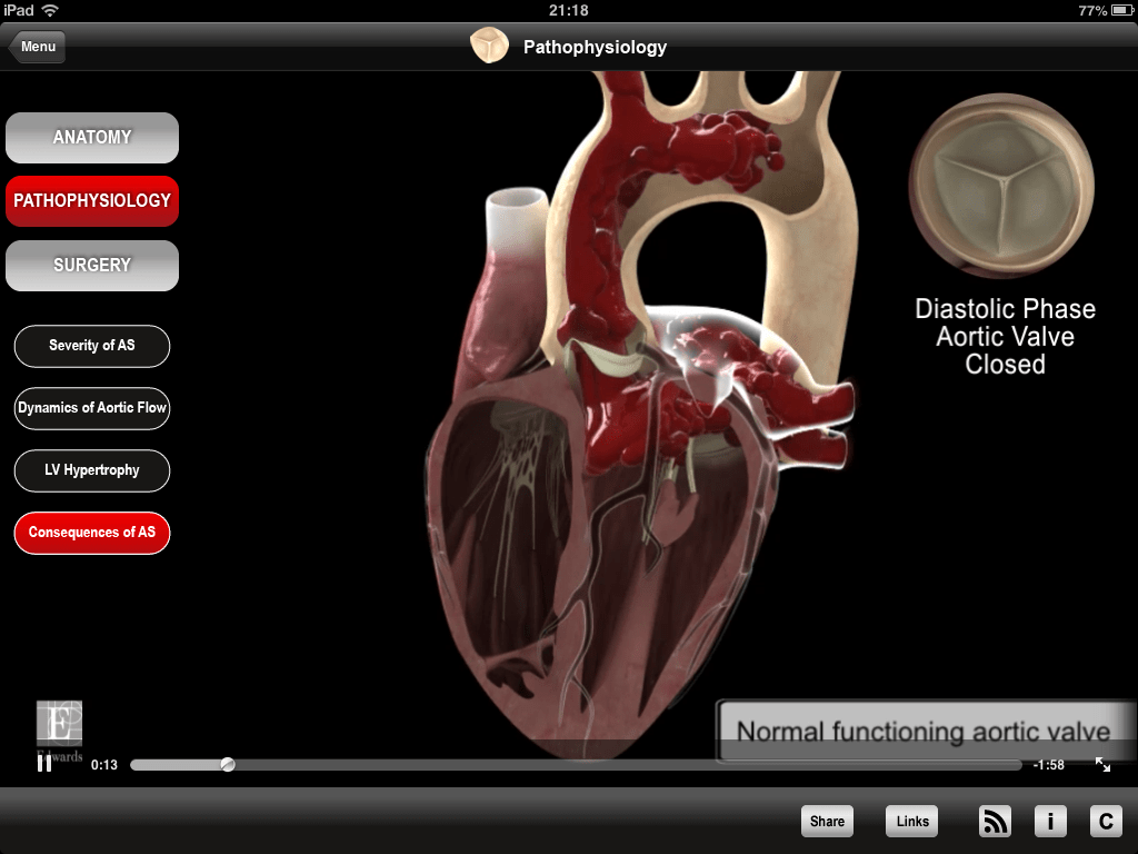 Edwards Heart Master app combines video and anatomical models for