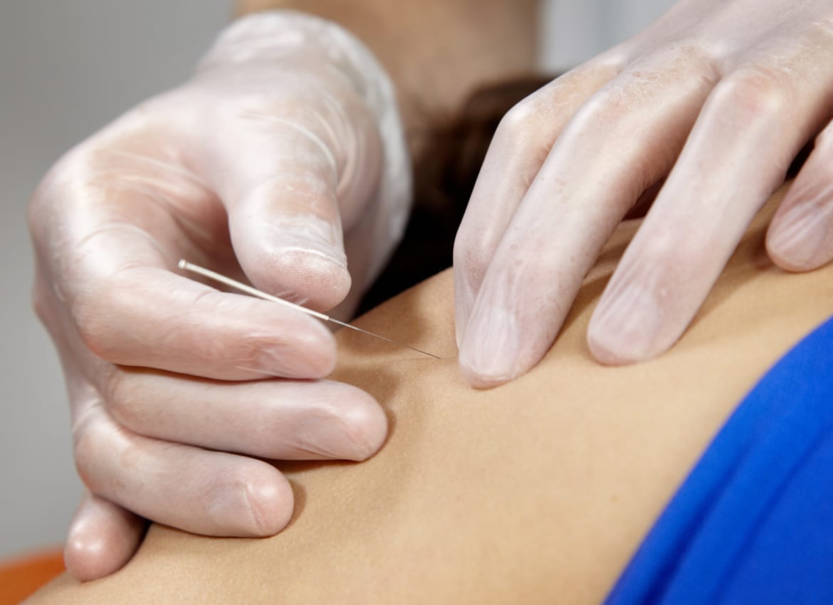 Trigger Point Dry Needling & Myofascial Pain Therapy IMPACT PT