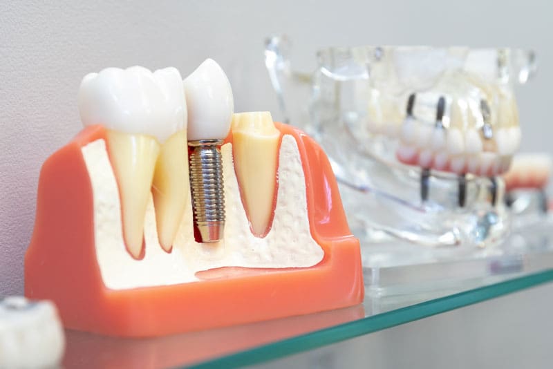 What is the Risk of Dental Implant Failure? Shenandoah Valley Implant