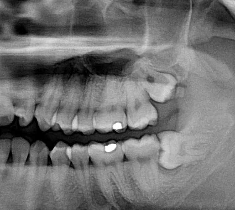 What is an Impacted Tooth?