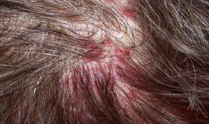 Beauty Tips: How To Get Rid Of Pimples On The Scalp