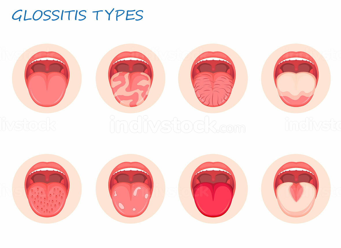 Types glossitis. Candidiasis of the tongue, thrush. Inflammation of the
