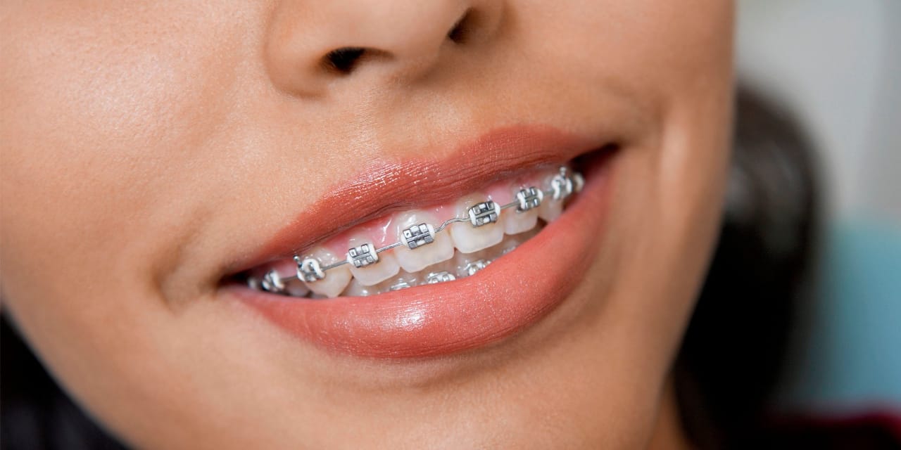 BRACES / ORTHODONTIST TREATMENT IN THANE Indus Dental