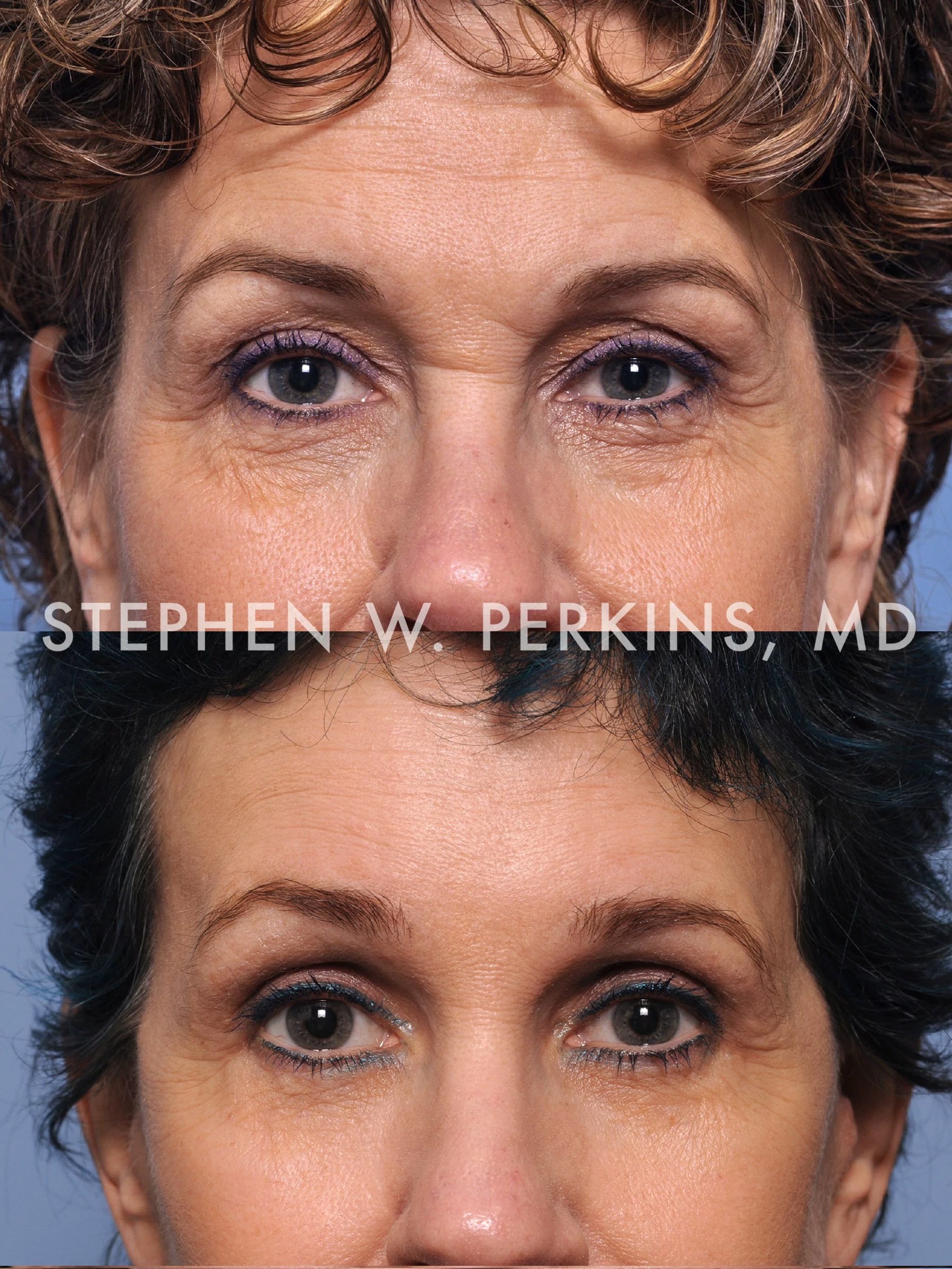 Eyelid Surgery Indianapolis Plastic Surgeons Dr. Stephen Perkins, MD