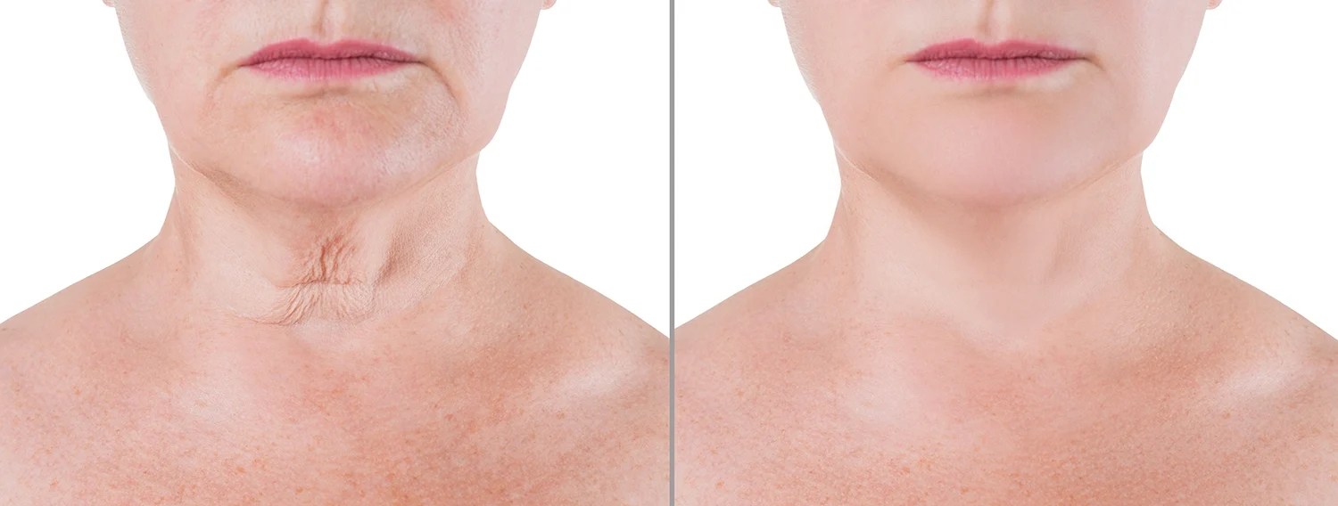 Neck Lift Procedure Cost 2024 What You Need to Know