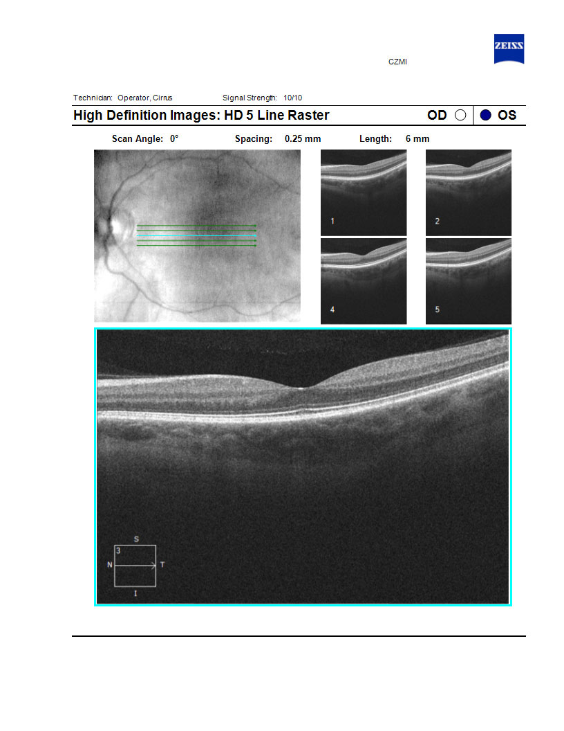 Retinal Eye Exam Dallas, TX Eye Exam Fort Worth Infinity Vision Dallas