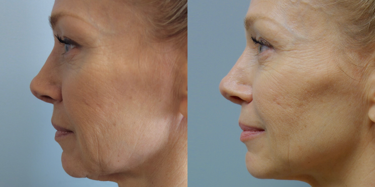 Non surgical Facelift Archives In Focus Ophthalmic Plastic Surgery